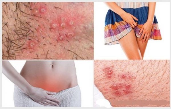 Mọc mụn ở vùng kín là bệnh gì ở nữ giới là vấn đề đang nhận được rất nhiều sự quan tâm hiện nay