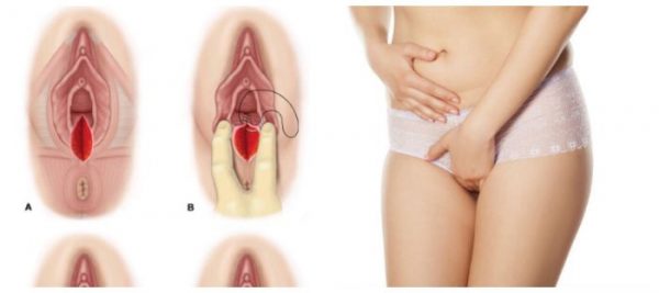 Thẩm mỹ vùng kín giúp cho chị em lấy lại được sự tin và thăng hoa hơn trong đời sống tình dục