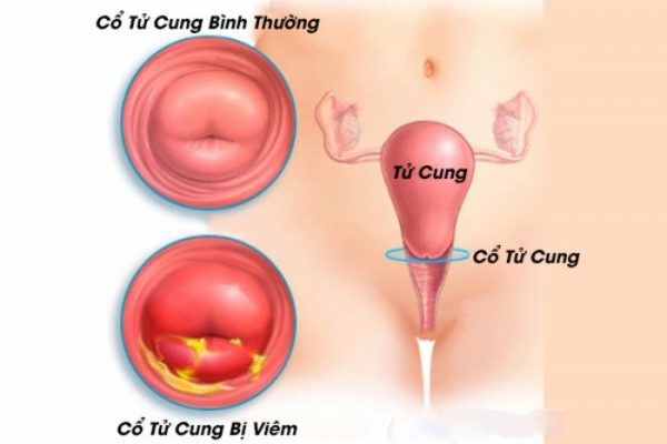 Viêm cổ tử cung là tình trạng ống cổ tử cung bị viêm, sưng do bị vi khuẩn, virus, ký sinh trùng xâm nhập