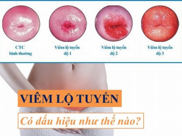 Biểu hiện của bệnh viêm lộ tuyến cổ tử cung là dịch tiết âm đạo bất thường