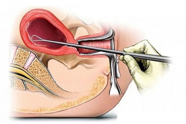 Viêm nội mạc tử cung có thể điều trị bằng thuốc hoặc phẫu thuật