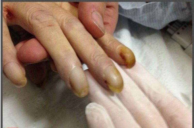 Ngón tay dùi trống là gì? Ngón tay dùi trống là biểu hiện của bệnh gì? 2 Ngón tay dùi trống là biểu hiện của nhiều bệnh lý khác nhau