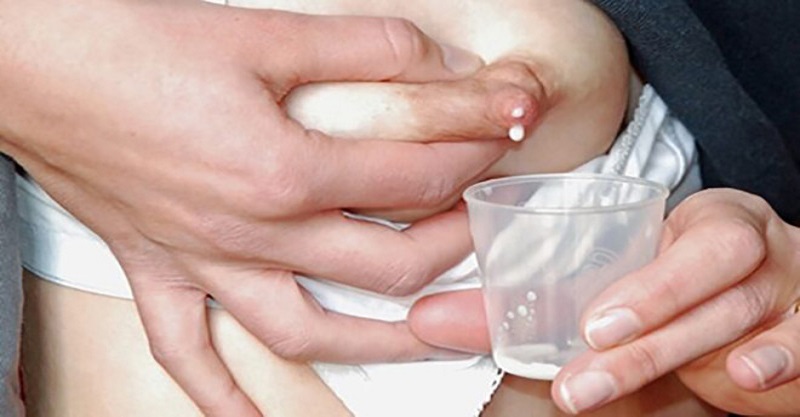 Nguyên nhân bị nhũ hoa có đốm trắng 2 Nhiễm trùng nấm có nguy cơ cao khiến nhũ hoa xuất hiện đốm trắng